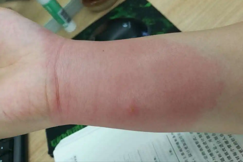 红火蚁是何方神圣？被红火蚁咬伤怎么办？